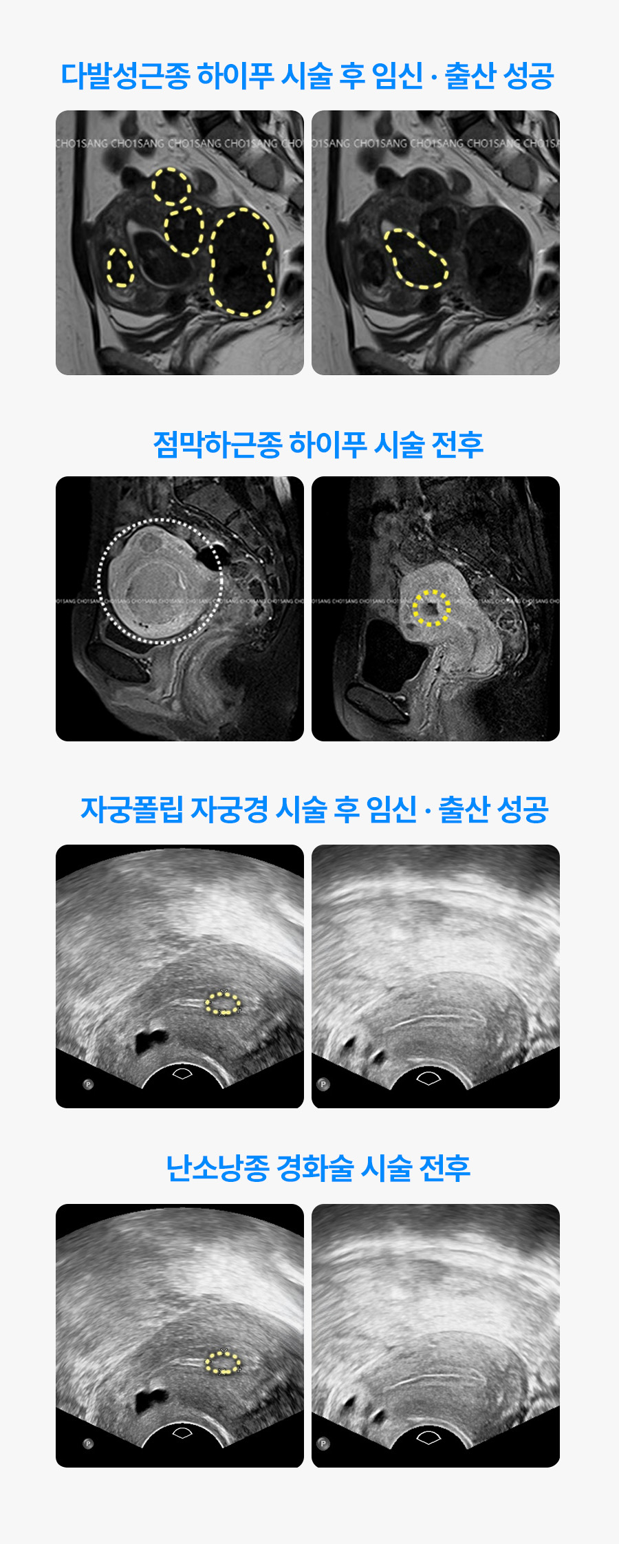 난소 기능 보존 상담